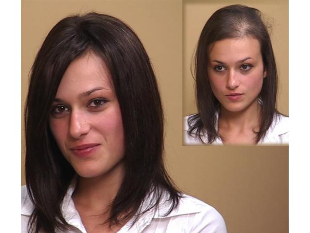 Smart Hair Clinic Provides Bonding And Products Is Smart Hair Clinic Provides Bonding And Products Is Very Easy Painless It Takes 1 Hour For The Treatment Available Foe Men
