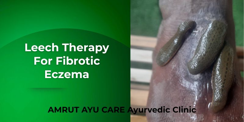 Leech Therapy For Ec