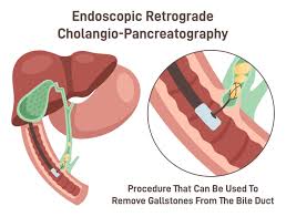 ERCP ( Endoscopic Re