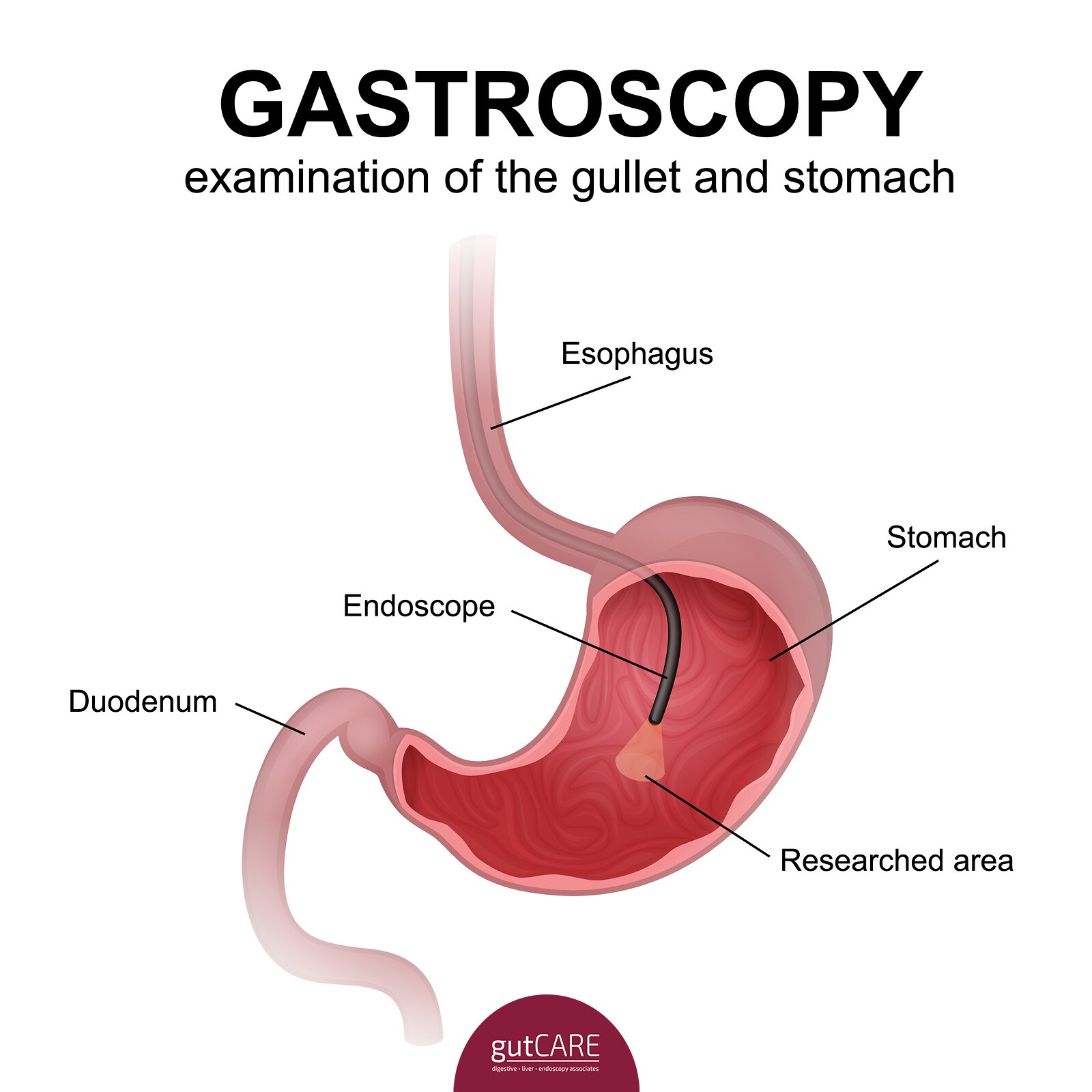 Gastrosocopy.jpg