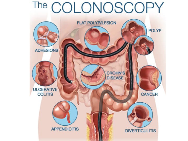Colonoscopy ( Lower 