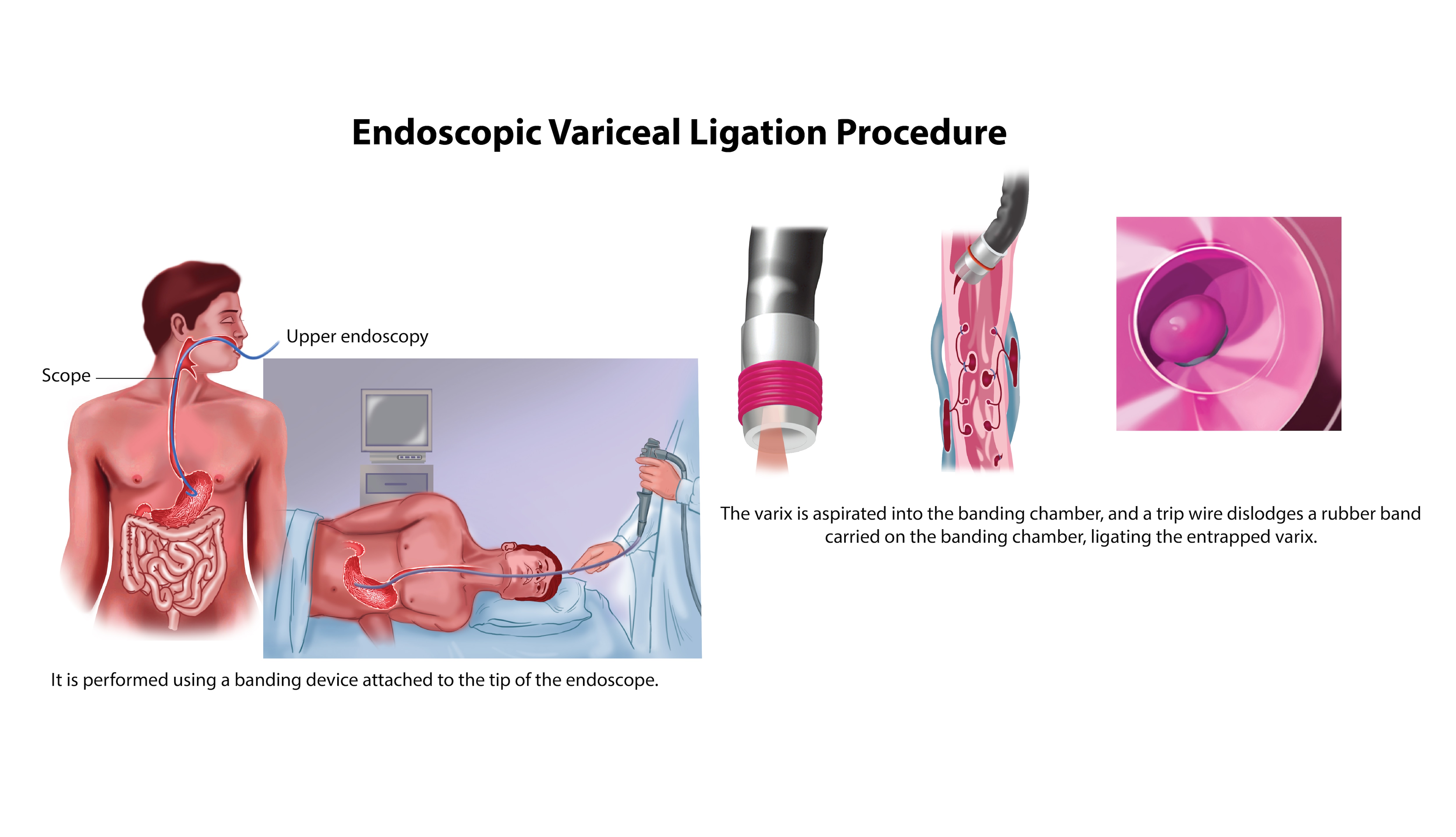 Endoscopic Variceal 