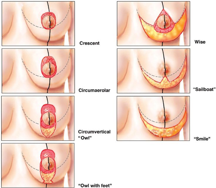 breast-lift-incision