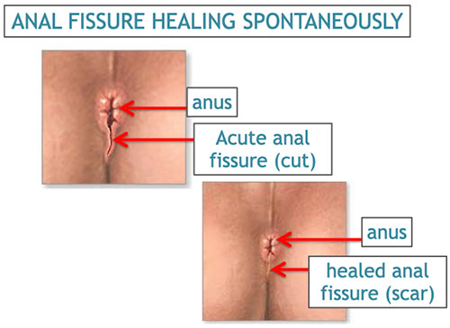 anal-fissures-img2.j
