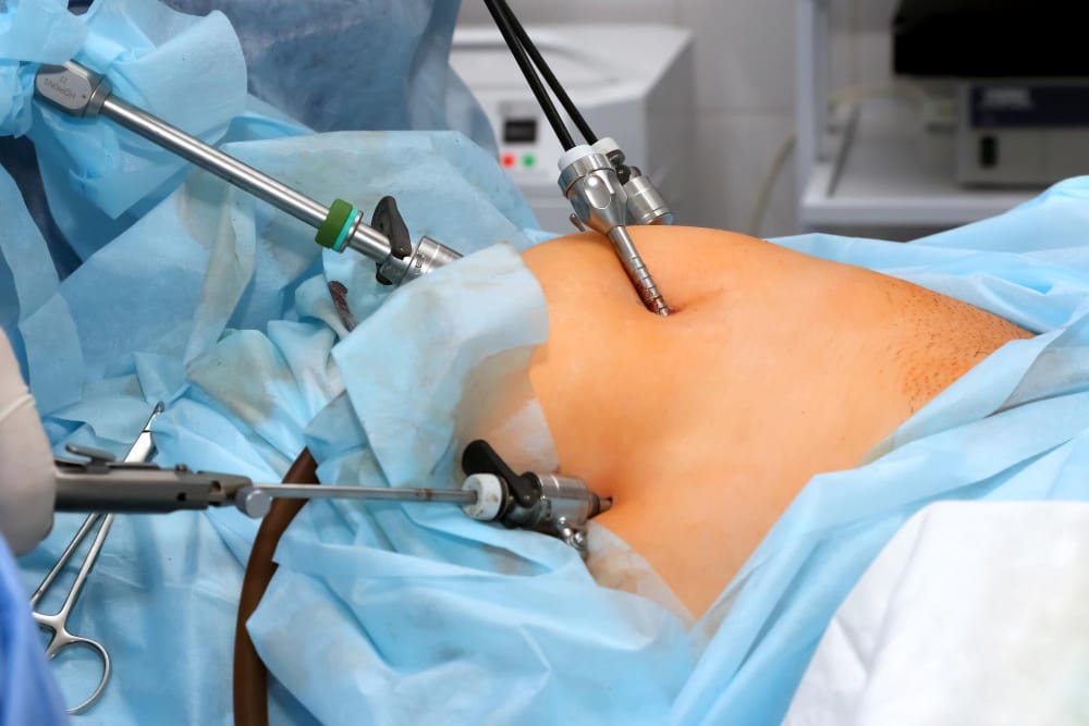 Laparoscopic-Surgeri