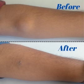 lipoma-removal_orig.