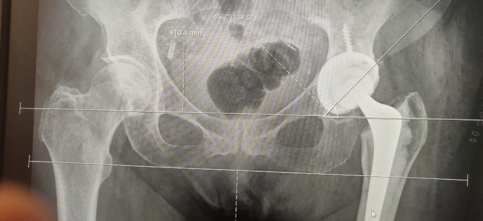 Hip Replacement.jpeg