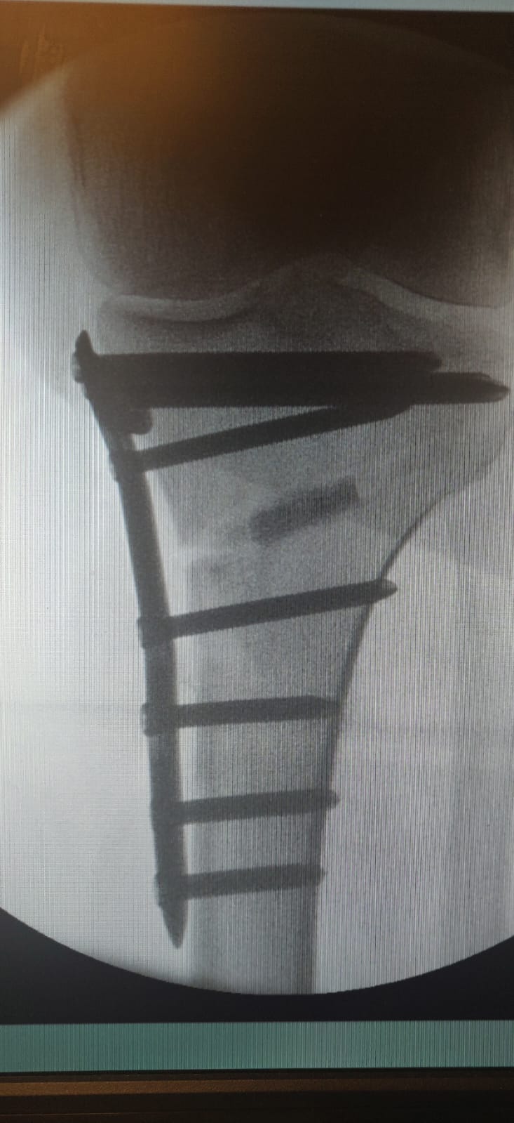 osteotomy 2.jpeg