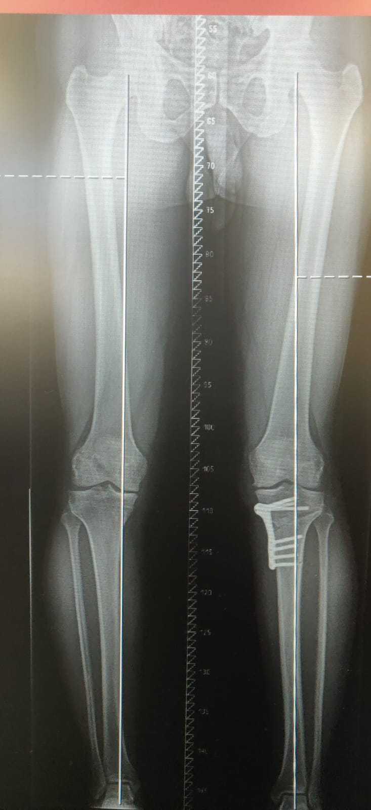 Osteotomy Post Op.jp