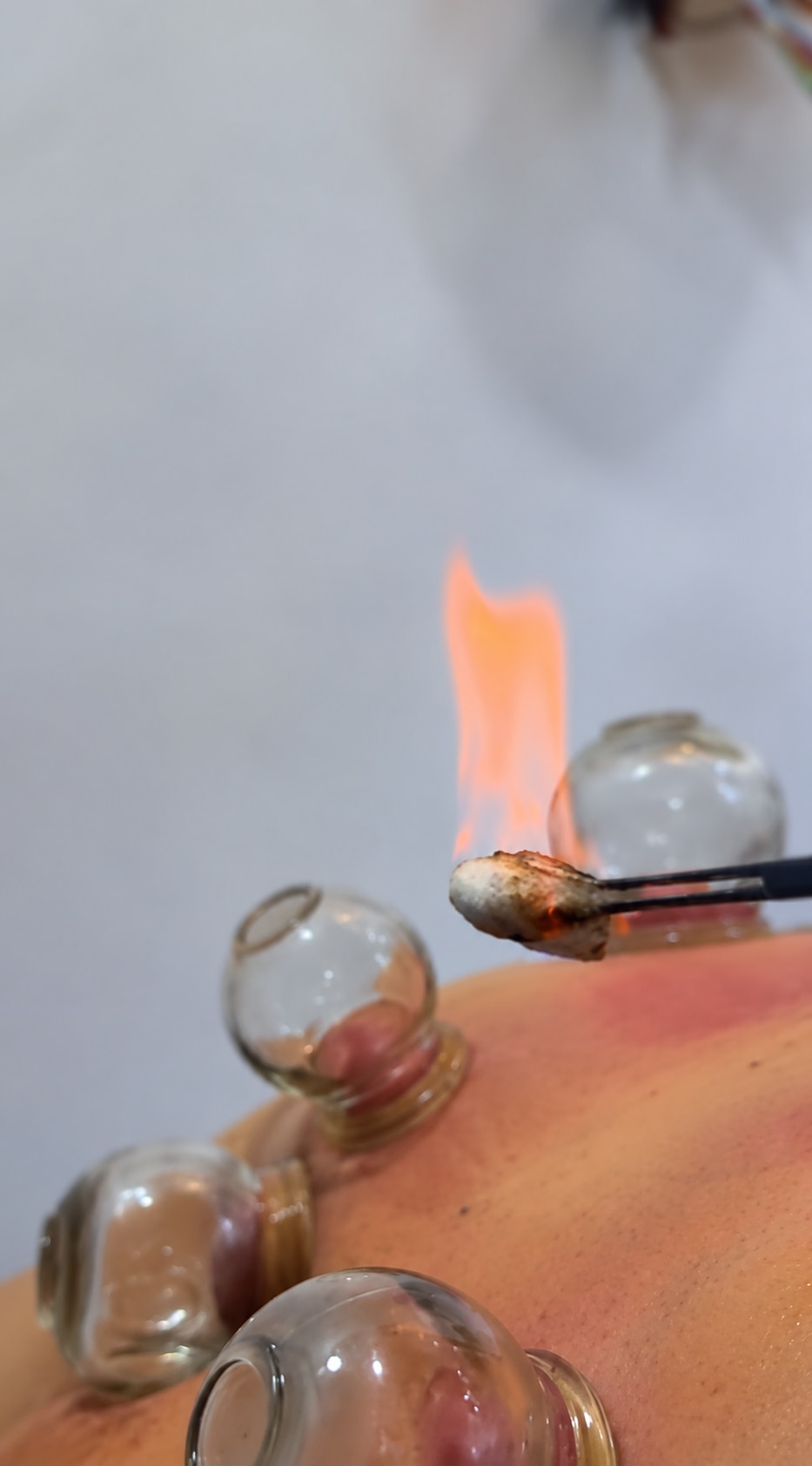 fire_cupping.png