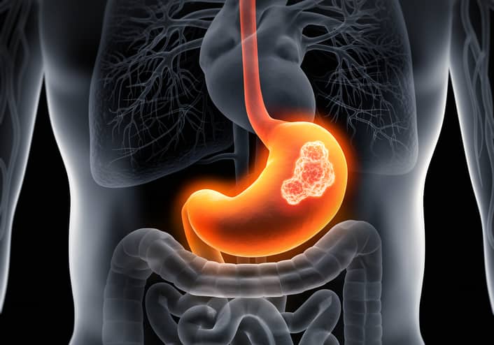 Stomach Cancer Gastr