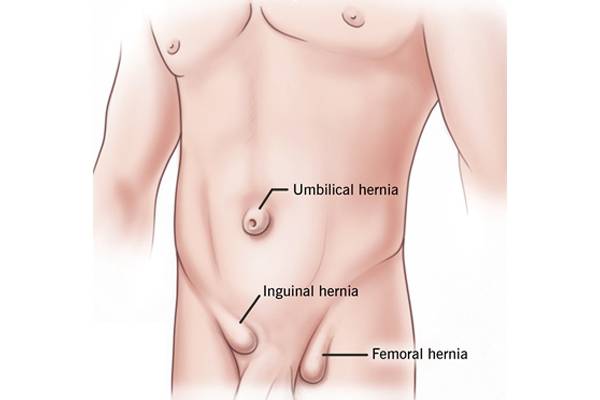 Hernia.jpg
