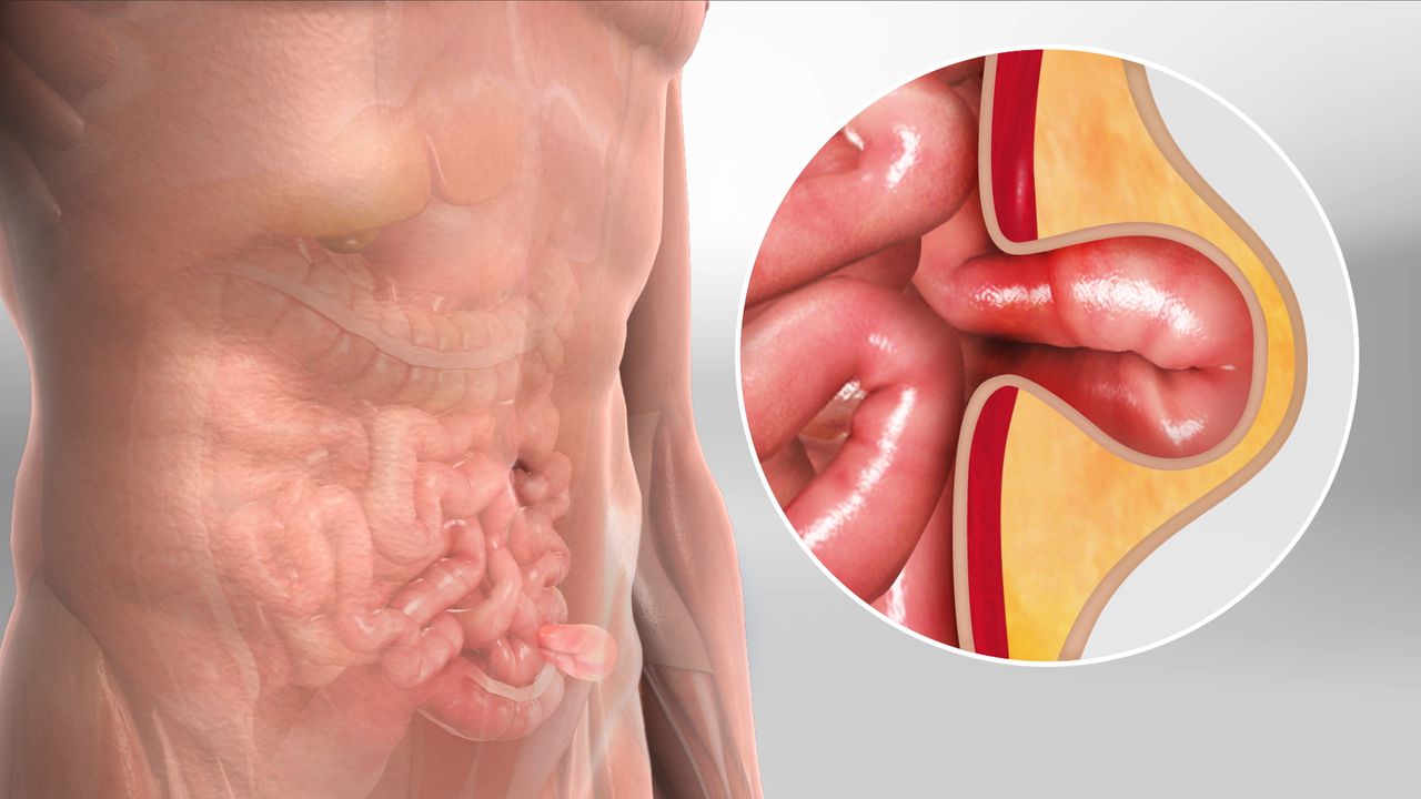 herniasurgery_1280.j