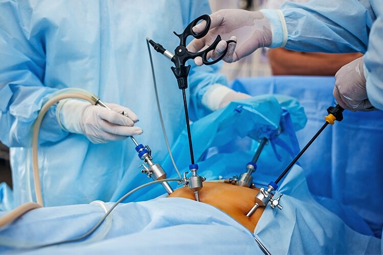 laparoscopic-surgery