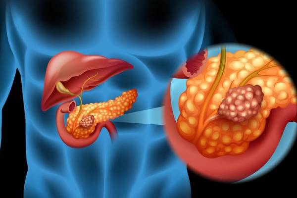 Pancreatic-Cancer.jp