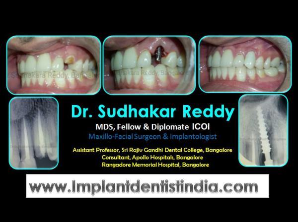Take 10 Minutes to Get Started With leading dental implant center in Dwarka