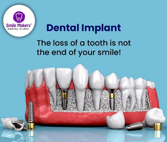 Smile Makers Dental Clinic,Pimple Saudagar,PCMC gallery